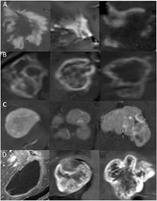 The value of convolutional neural networks-based deep learning model in differential diagnosis of space-occupying brain diseases